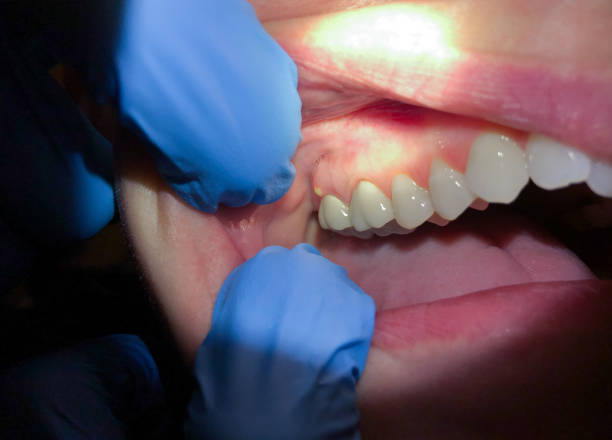 Best Emergency Treatment for Oral Infections in Lake Nacimiento, CA